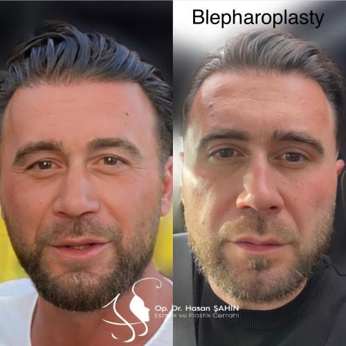 Before after photos of our patients - Eyelid surgery - OP. Dr. Hasan Sahin